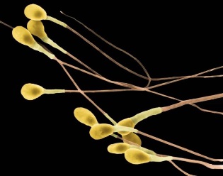 Причины агглютинации сперматозоидов, методы диагностики и лечения патологии